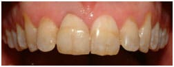 11 Layered Zirconia Crown