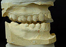 “B” Splints 1 “B” Splints 1