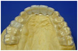 Biocryl Temporary Removable Partial Dentures 1