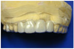 Biocryl Temporary Removable Partial Dentures 2