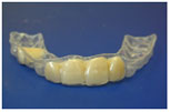 Biocryl Temporary Removable Partial Dentures 3