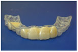 Biocryl Temporary Removable Partial Dentures 3 Biocryl Temporary Removable Partial Dentures 3