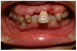 Patient with missing teeth