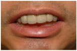 Patient with Biocryl Temporary Removable Partial Dentures