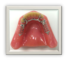 Partial Denture 1 Partial Denture 1