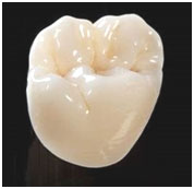 Multi-Layered Full Contour Milled Zirconia Restorations