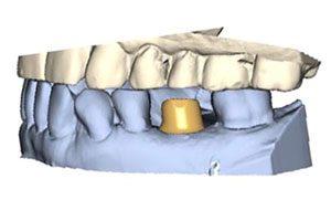 Custom Abutments and Substructure 1