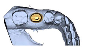 Custom Abutments and Substructure 2