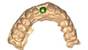 Custom Abutments and Substructure 6