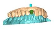 Custom Abutments and Substructure 3