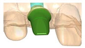 Custom Abutments and Substructure 4