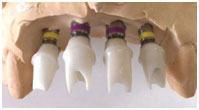 Titanium Base (Ti Base) 1 Titanium Base (Ti Base) 1