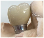 Zirconia screw retained restorations