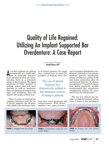 Bar Overdenture Article