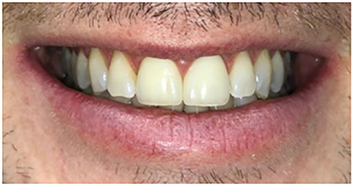 After porcelain layered crowns After porcelain layered crowns