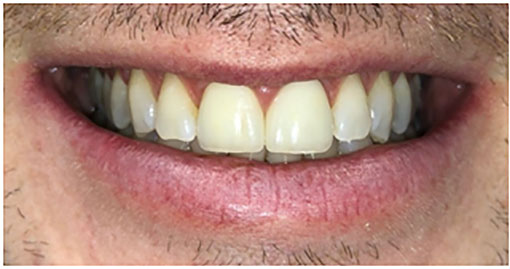 After porcelain layered crowns