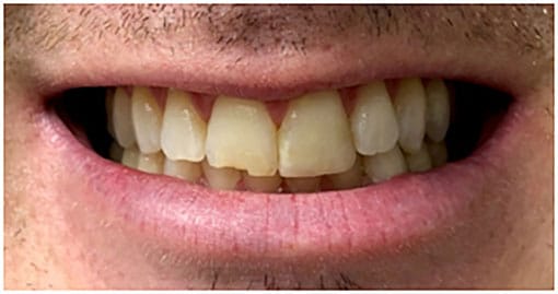 Before porcelain layered crown Before porcelain layered crown