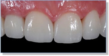 The Final Case Close Up – e.Max Anteriors with Right Lateral Implant and Zirconia Abutment