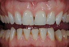Porcelain Veneer- Before 1 Porcelain Veneer- Before 1