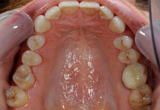 Porcelain Veneer- Before 2 Porcelain Veneer- Before 2
