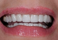 Porcelain Veneer- After 1 Porcelain Veneer- After 1