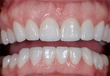Porcelain Veneer- After 2 Porcelain Veneer- After 2