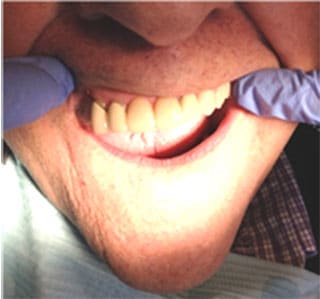 O-So O-Ring Over Denture Attachment- After O-So O-Ring Over Denture Attachment- After