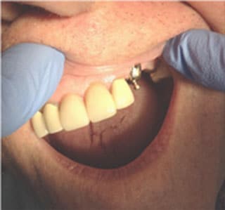 O-So O-Ring Over Denture Attachment-Before