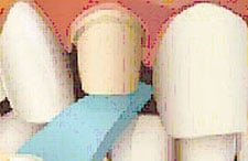 Occlusal Clearance Occlusal Clearance