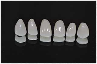 Max Crowns and Veneer