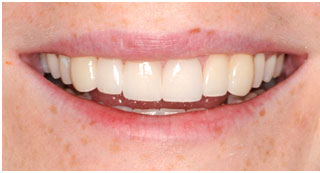 After Cosmetic Restoration After Cosmetic Restoration
