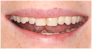 Before Cosmetic Restoration Before Cosmetic Restoration