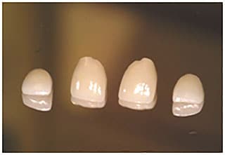 Restorations for Bonding Restorations for Bonding