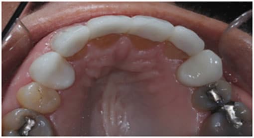 The Final Case Close Up – e.Max ¾ Layered Anterior Crowns for All 4 Incisors