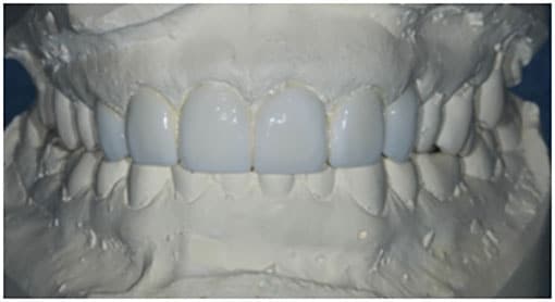 Diagnostic Wax Up Diagnostic Wax Up