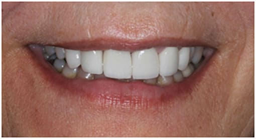 The Final Case Close Up – e.Max Layered Crowns to Alter the 1st Bicuspids to look Like Cuspids