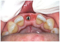 Implant Integration Implant Integration
