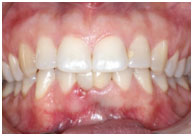 Labial View of Final Labial View of Final