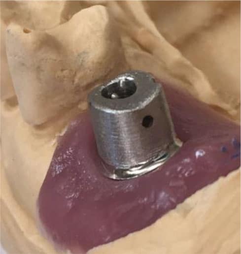 Cement retained implant restoration