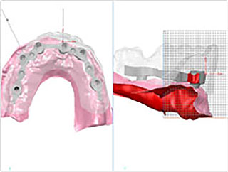 3I Biomet CAM StructSURE Software