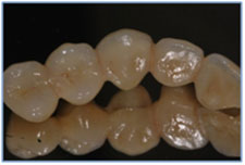 5 Unit Lava Zirconia Based Bridge