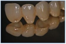 5 Unit Lava Zirconia Based Bridge