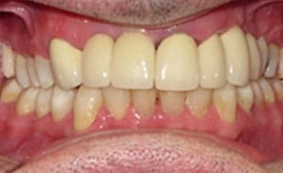 Post-Treatment 2 Post-Treatment 2