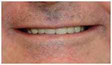 Post-Treatment Post-Treatment