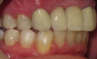 Post-Treatment 1 Post-Treatment 1