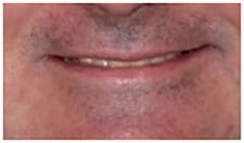 Pre-Treatment Pre-Treatment