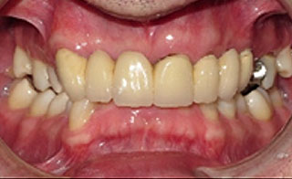 Pre-Treatment 2 Pre-Treatment 2