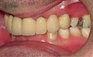 Pre-Treatment 3 Pre-Treatment 3