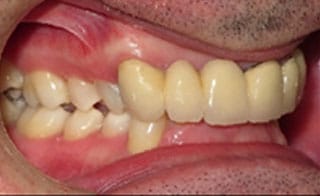 Pre-Treatment 1 Pre-Treatment 1