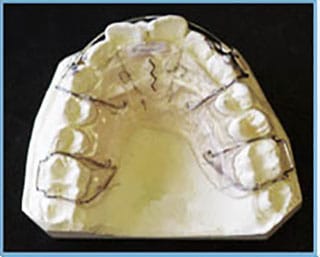 Maxillary Removable Expansion Appliance